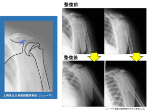 上腕骨近位骨端線離開骨折|整復前後のレントゲン写真