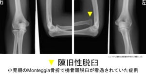 陳旧性脱臼(橈骨頭脱臼)